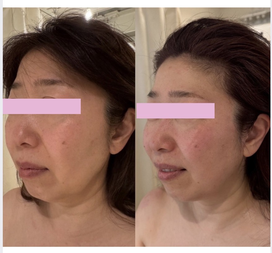 QWEENs MOUTHの施術事例:横顔の記録
