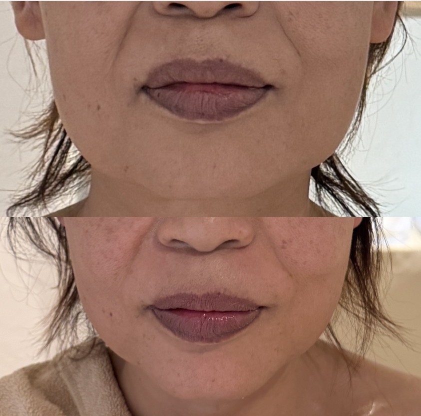 QWEENs MOUTHの施術事例:口元・フェイスラインの記録